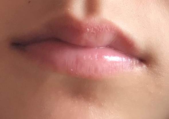 Lippen geschwollene Geschwollene Lippe