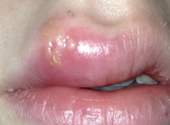 Lippenherpes - (Gesundheit, Lippe, Herpes)