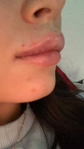 Geschwollen wie lippen aufspritzen lange Lippen aufspritzen?