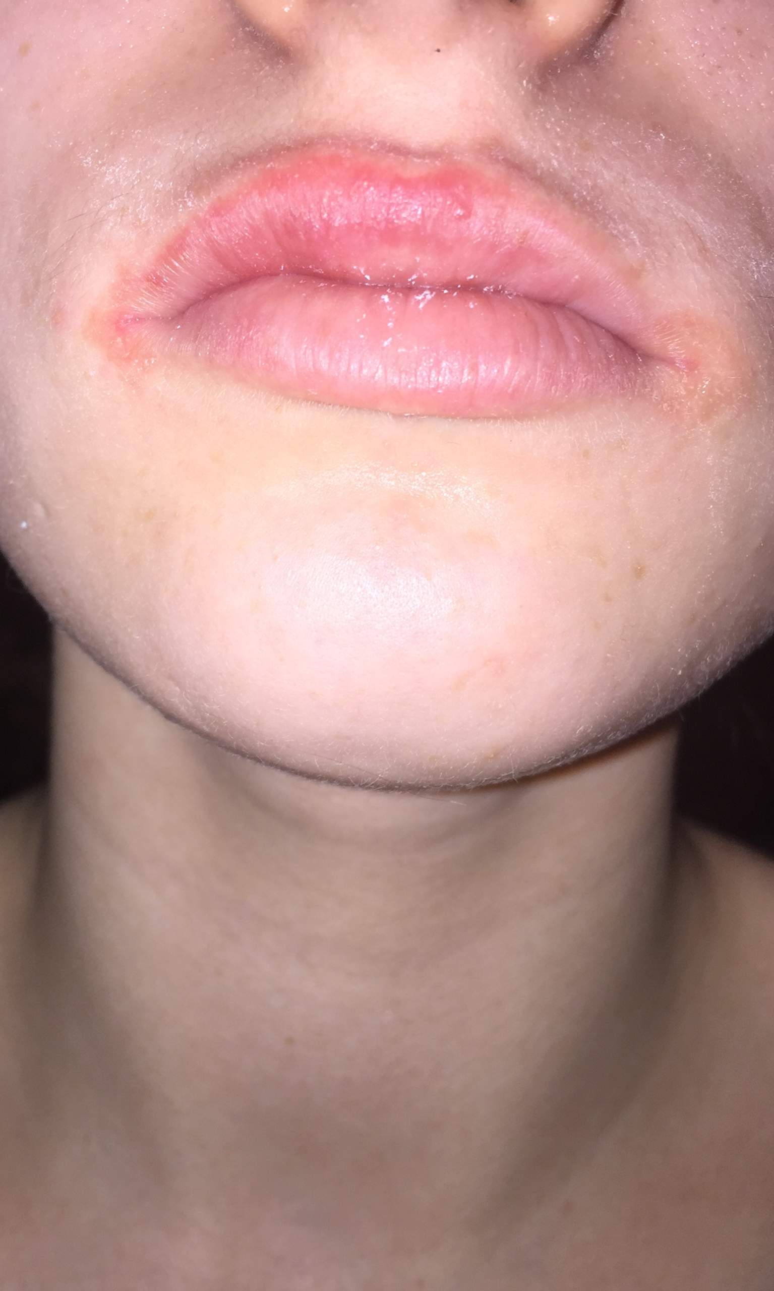 Lippen rot und geschwollen ,was ist das und wie weg kriegen ...