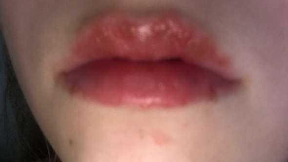 Lippen Tun Schmerzhaft Wehx Gesundheit Und Medizin Arzt Krankheit