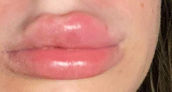 Lippen Unterspritzung professionell gemacht?