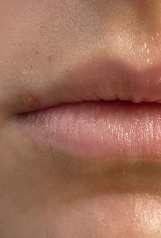 Lippen-Unterspritzung trotz Pickel?