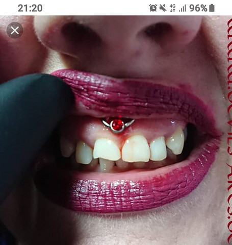 Lippenbändchen piercing entzündet