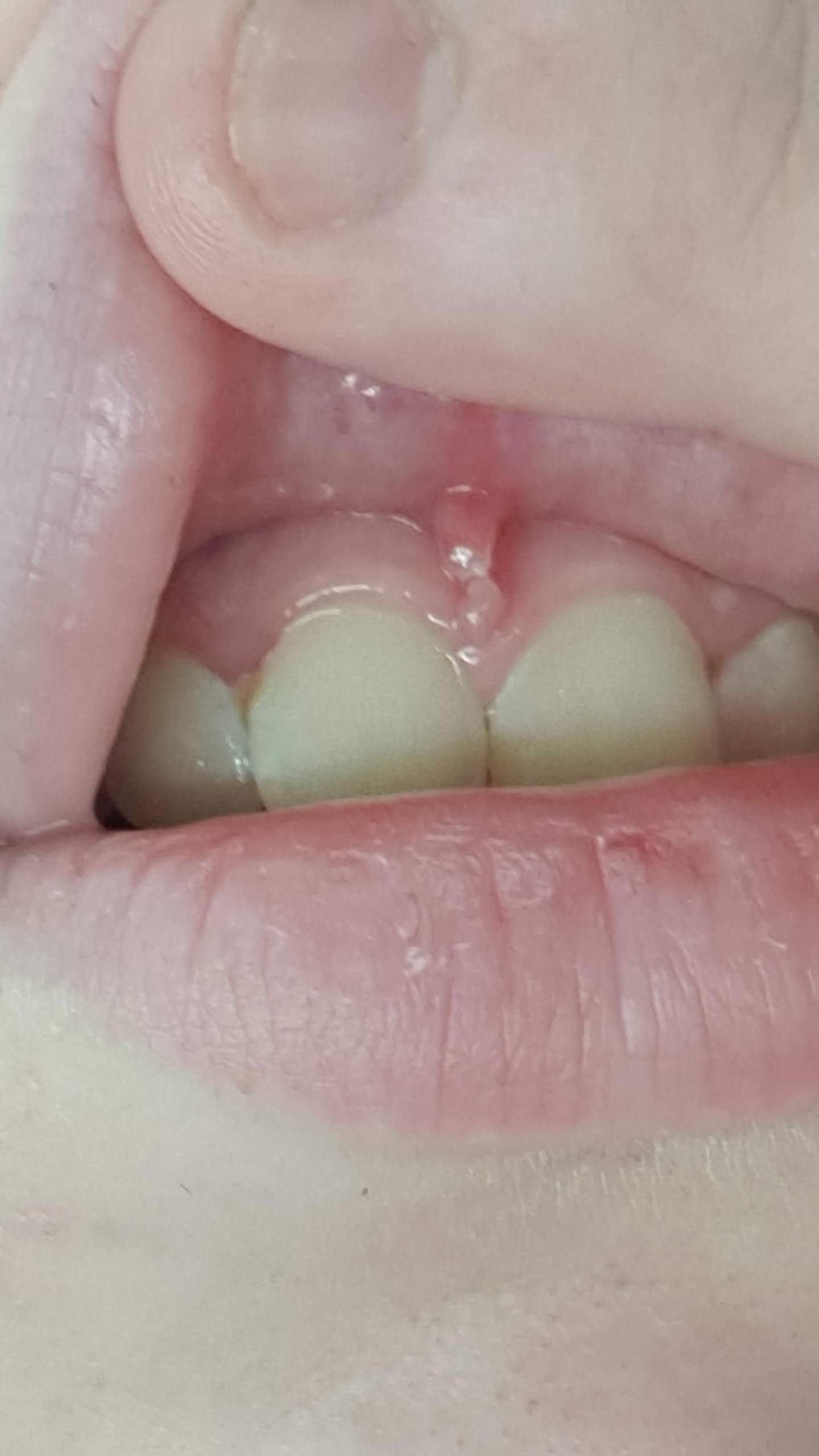 Lippenbändchen piercing gerissen, neustechen möglich?? (Piercer, Piercingstudio)