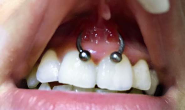 lippenbandchen piercing gerissen oder nicht gesundheit und medizin piercer piercingstudio