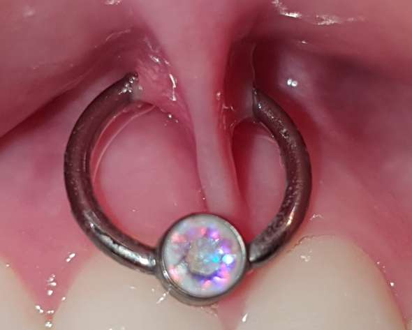 lippenbandchenpiercing schief gestochen oder geschwollen gesundheit und medizin piercing schmuck