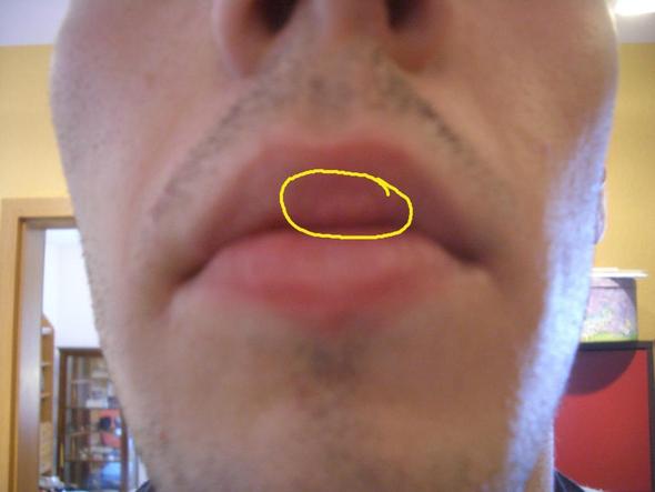 Lippeninnenseite Weisse Flecken Was Konnte Das Sein Hygiene Lippe Mund Lippeninnenseite Weisse Flecken Was Konnte Das Sein Hygiene Lippe Mund