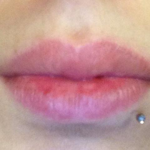 Lippenrand Rot Brennen Lippe