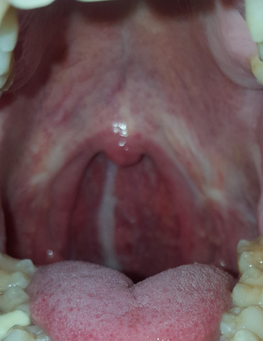 Liquorverlustsyndrom Post Nasal Drip Gesundheit Medizin Medikamente Liquorverlustsyndrom Post Nasal Drip Gesundheit Medizin Medikamente