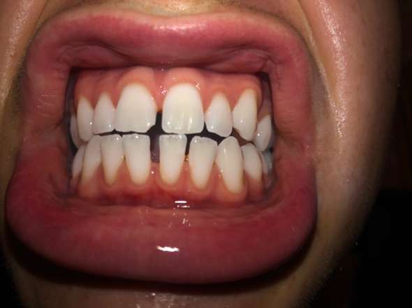Lispeln durch Zahnlücke?