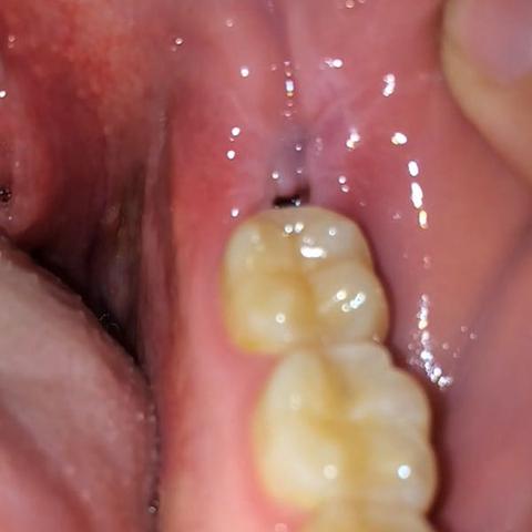 Loch in Zahnfleisch - (Zähne, Weisheitszähne, Zahnfleisch)