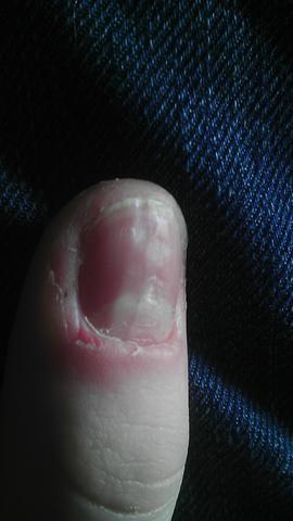 loch im fingernagel bitte helft mir fingernagel hausarzt
