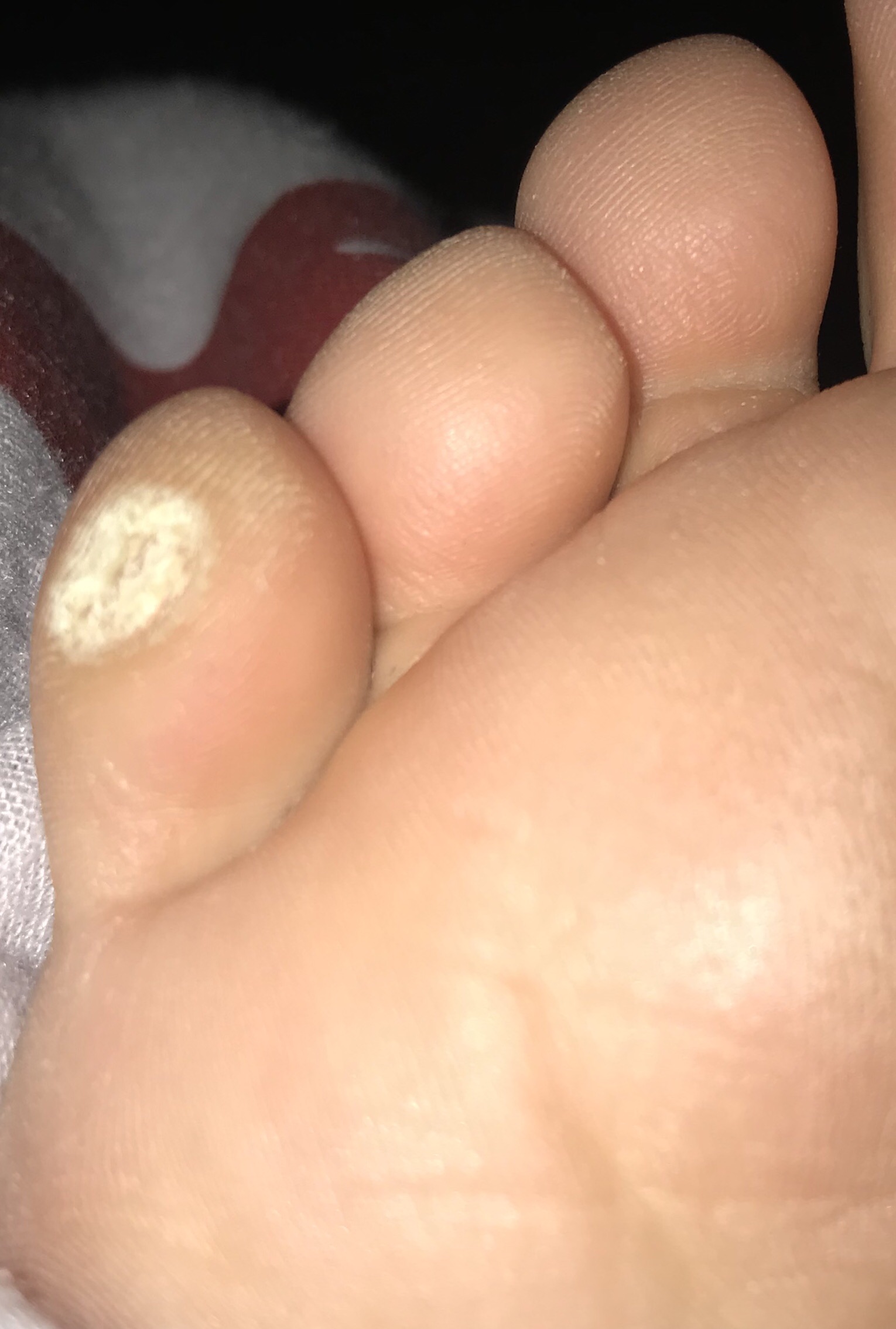 Loch Im Fuss Woher Kommt Das Gesundheit Und Medizin Gesundheit Korper Loch Im Fuss Woher Kommt Das Gesundheit Und Medizin Gesundheit Korper