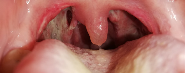 Loch Im Hals Nach Mandel Op Gesundheit Und Medizin Halsschmerzen