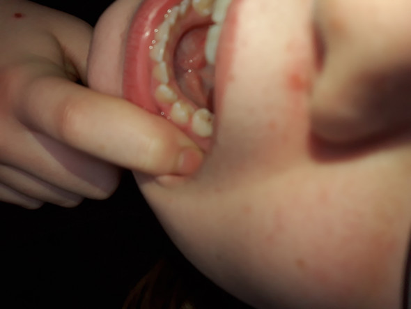 Loch Im Zahn Oder Was Ist Das Gesundheit Und Medizin Umfrage Abstimmung Loch Im Zahn Oder Was Ist Das Gesundheit Und Medizin Umfrage Abstimmung