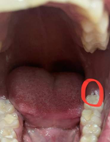 Loch im Zahnfleisch hinter dem Backenzahn?