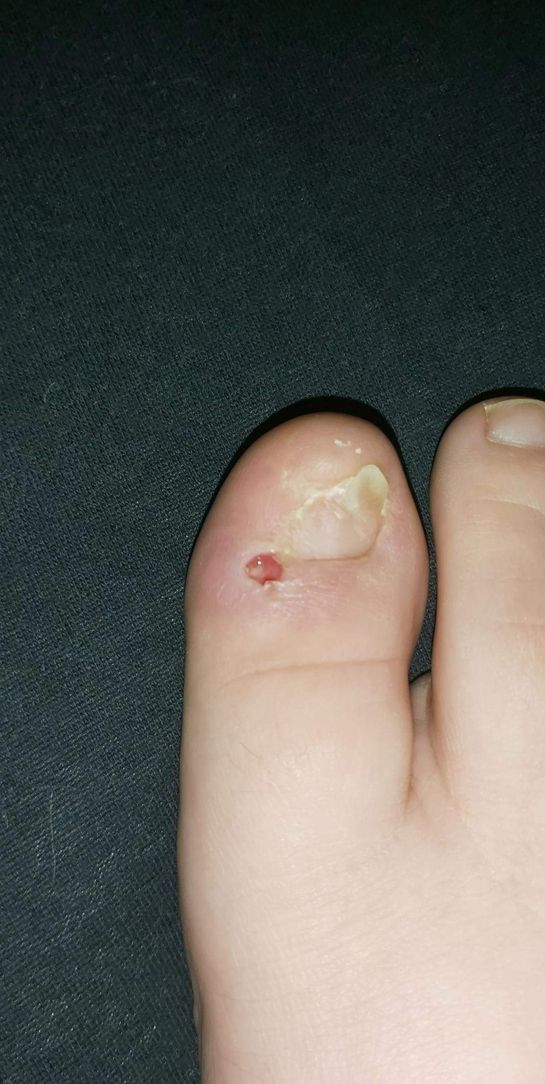 Loch im Zeh nach Operation? (Gesundheit und Medizin, Gesundheit, Arzt)