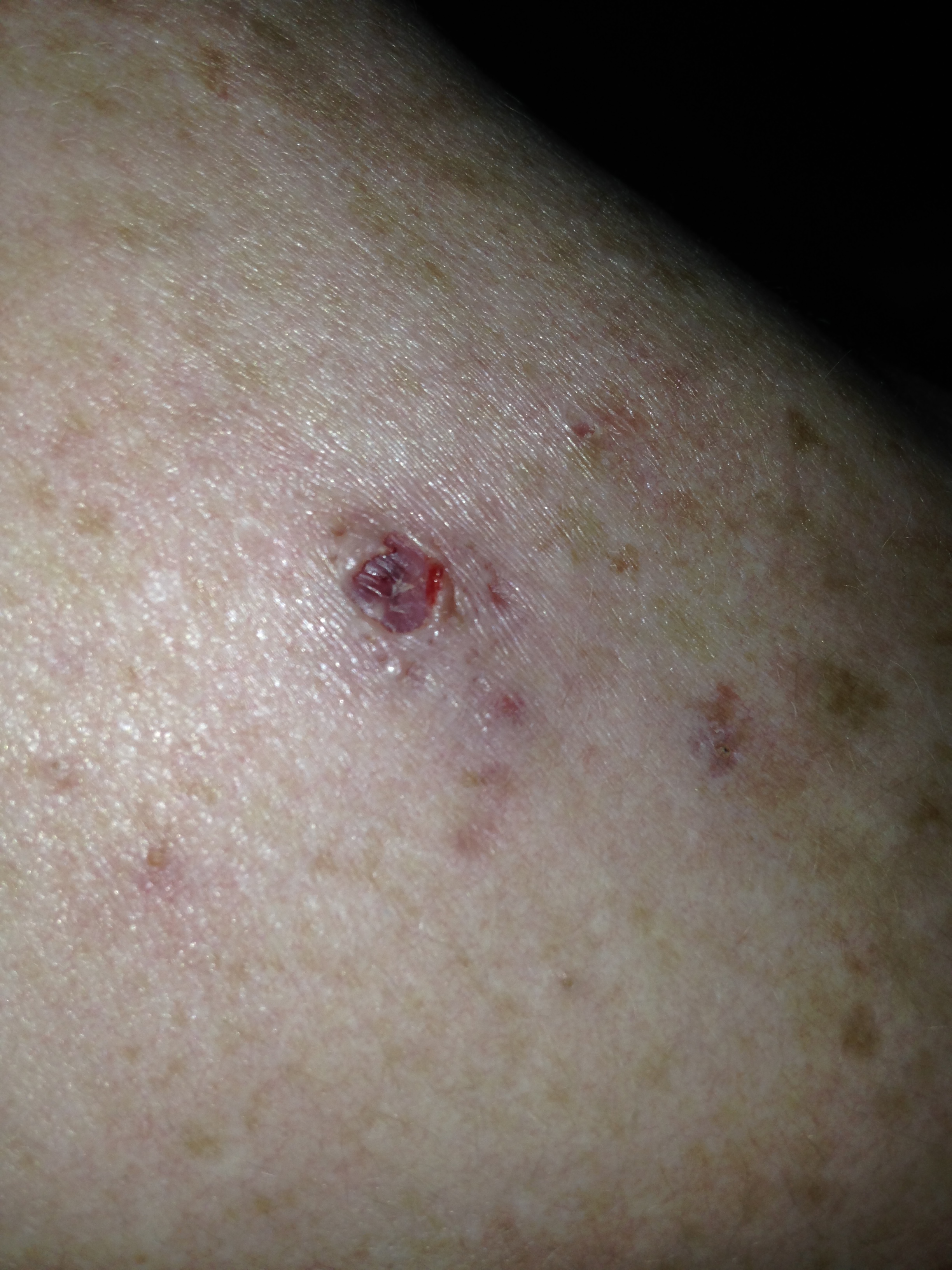 Loch In Der Haut Hiiiilfe Pickel Loch In Der Haut Hiiiilfe Pickel