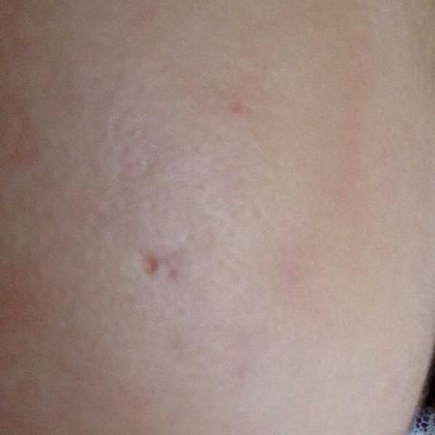 Loch In Der Haut Wegen Akne Wie Kriege Ich Es Weg Und Wurdet Ihr Manner Eine Frau Deswegen Nicht Wollen Liebe Gefuhle Treffen Loch In Der Haut Wegen Akne Wie Kriege Ich Es Weg Und Wurdet Ihr Manner Eine Frau Deswegen Nicht Wollen Liebe Gefuhle Treffen