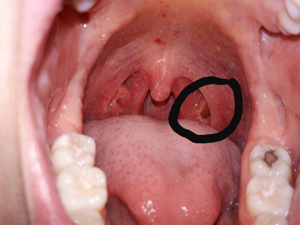 Loch In Der Mandel Normal Gesundheit Und Medizin Gesundheit Arzt Loch In Der Mandel Normal Gesundheit Und Medizin Gesundheit Arzt