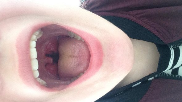 Loch In Der Mandel Was Nun Krank Mandeln Loch In Der Mandel Was Nun Krank Mandeln