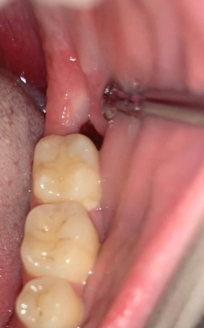 Loch nach Weisheitszahn-OP? (Weisheitszähne)