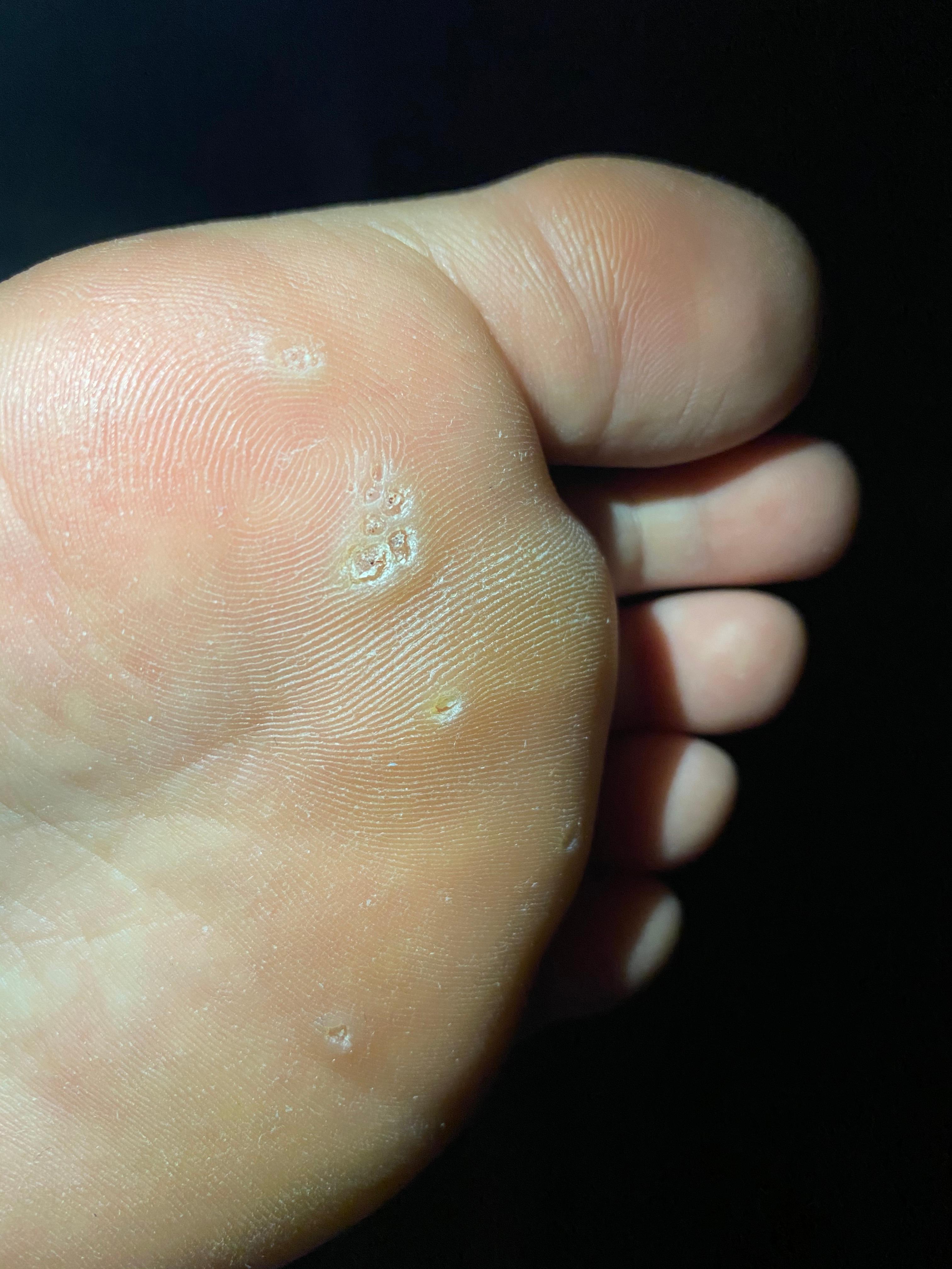 Locher An Der Fusssohle Was Kann Das Sein Medizin Loch Fusspilz Locher An Der Fusssohle Was Kann Das Sein Medizin Loch Fusspilz