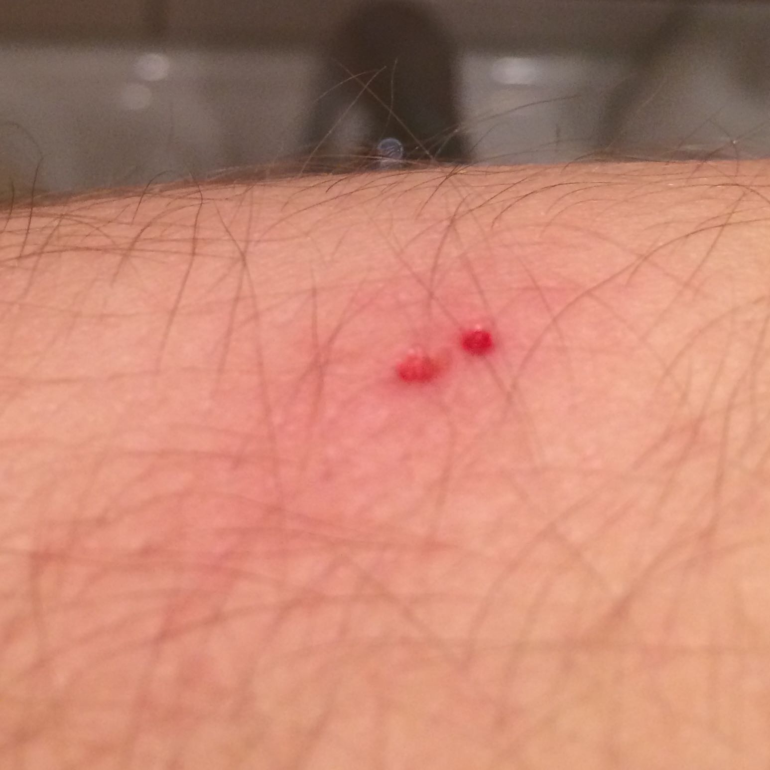 Löcher auf Arm was kann das sein? (Haut, Loch, Parasiten)