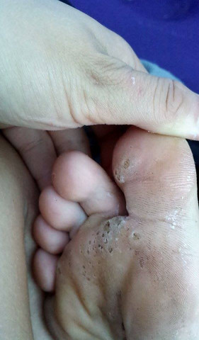 Was Konnten Das Fur Locher An Der Fusssohle Sein Krankheit Haut Fusse Was Konnten Das Fur Locher An Der Fusssohle Sein Krankheit Haut Fusse