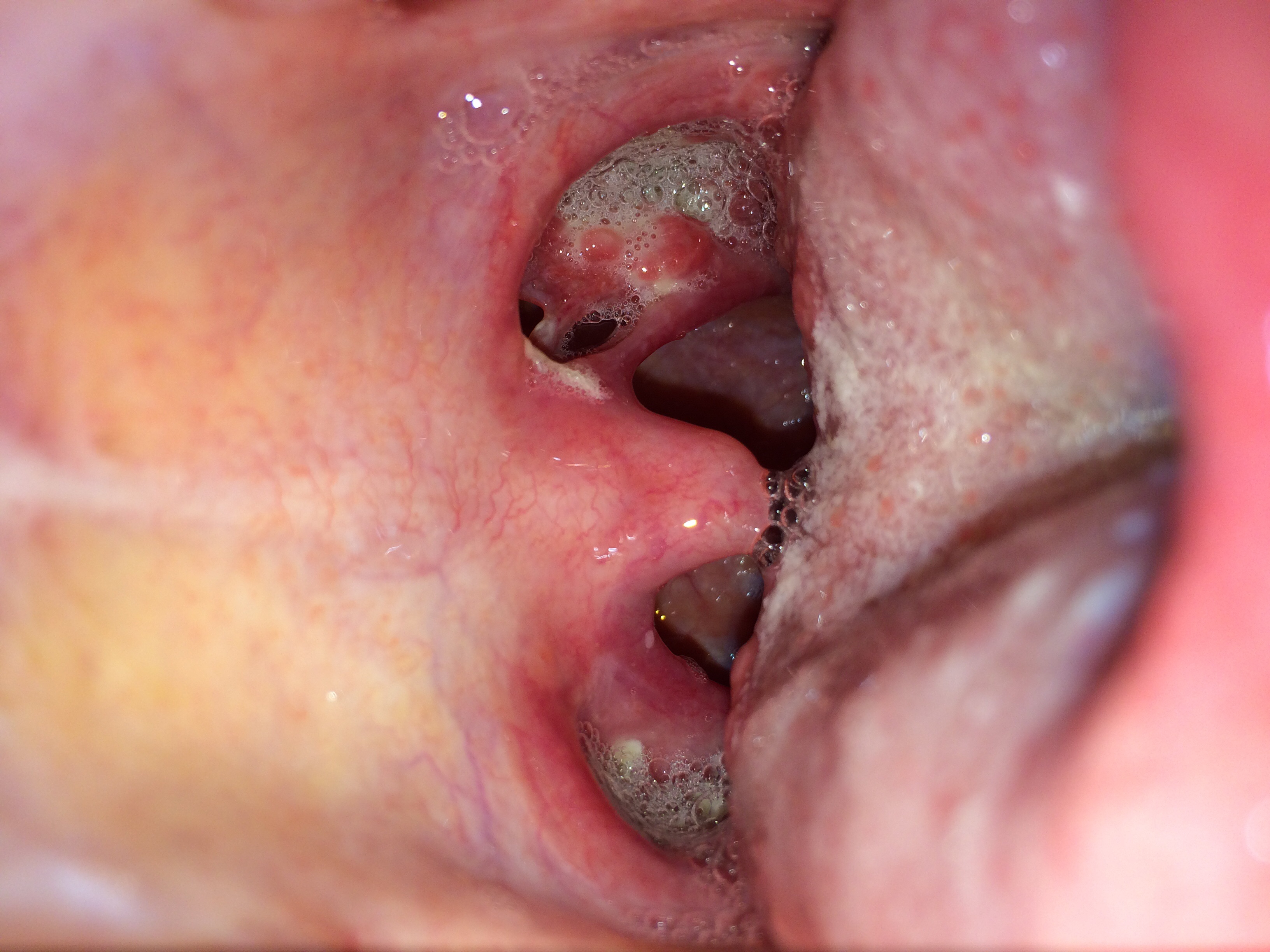 Löcher im Hals nach MandelOp (Mandeln) Löcher im Hals nach MandelOp (Mandeln)