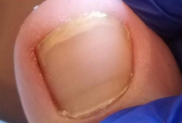 lost sich der nagel ab medizin nagel nagelpilz