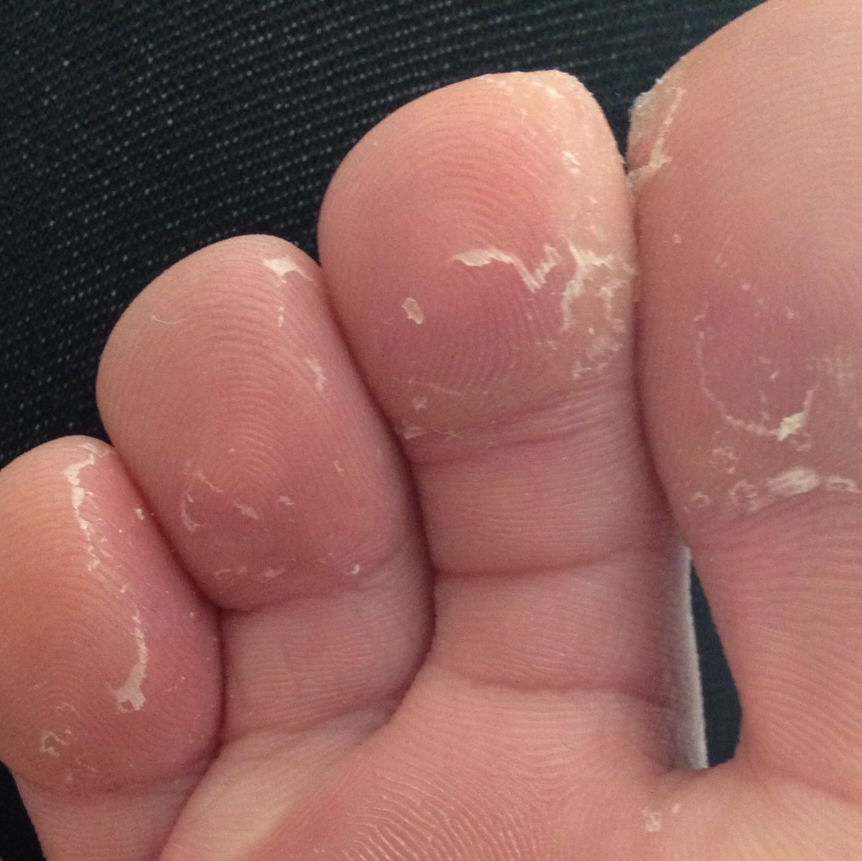 Erregung Feindseligkeit bisschen haut am fuß schält sich und juckt Linie Matrix Boost Erregung Feindseligkeit bisschen haut am fuß schält sich und juckt Linie Matrix Boost