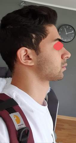 Lohnt Es Sich Eine Kinn Op Siehe Bild Gesicht Attraktivitat Schonheits Op