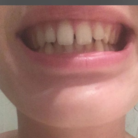 Grosse zahnlücke zwischen den schneidezähnen
