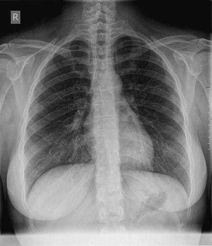 Thorax Ebene 1 - (Röntgen, Lungenembolie, Thoraxschmerzen)