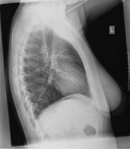 Thorax Ebene 2 - (Röntgen, Lungenembolie, Thoraxschmerzen)