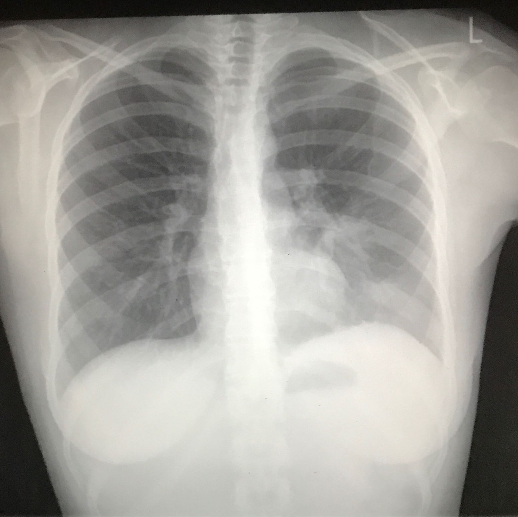 Lungenkrebs? Kennt sich jemand mit Röntgenbilder aus? (Gesundheit und Medizin, röntgen, Karzinom) Lungenkrebs? Kennt sich jemand mit Röntgenbilder aus? (Gesundheit und Medizin, röntgen, Karzinom)