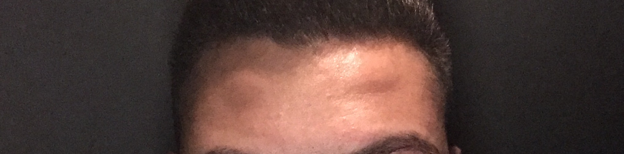 Lupome Oder Schlimmer Beulen An Der Stirn Gesundheit Medizin Haut