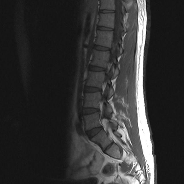 Lws MRT bilder liegt ein Bandscheibenvorfall? Lws MRT bilder liegt ein Bandscheibenvorfall?
