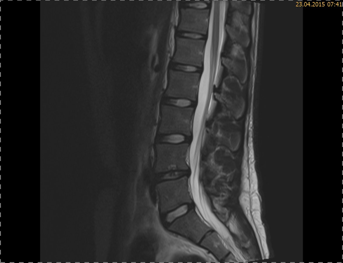 LWS MRT (Wirbelsäule) LWS MRT (Wirbelsäule)