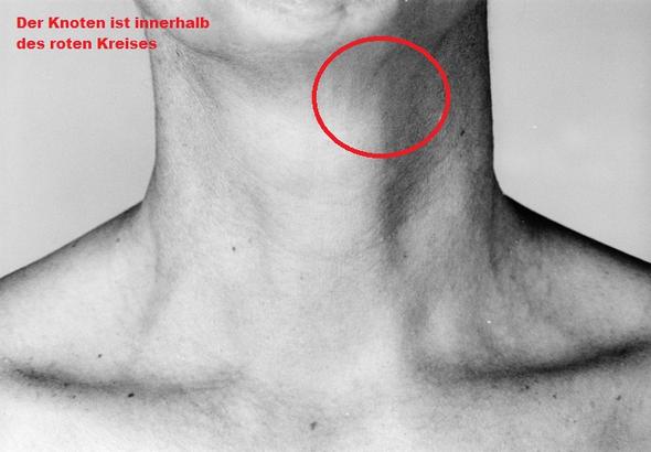 Wo Befinden Sich Lymphknoten Am Hals