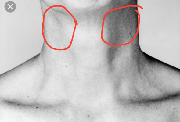 Geschwollener lymphknoten am hals rechts