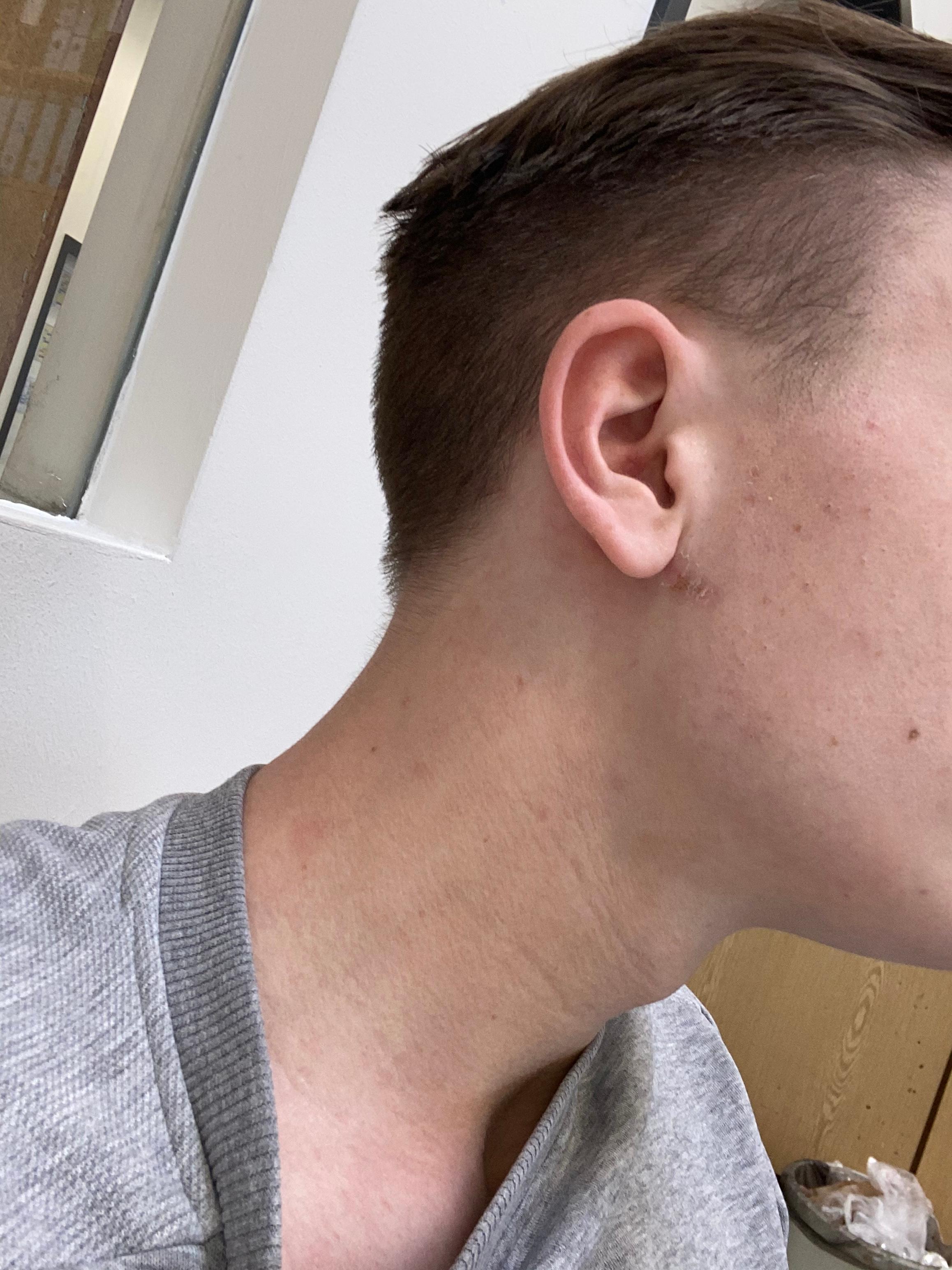 Drüsen Hinter Dem Ohr Captions Hunter