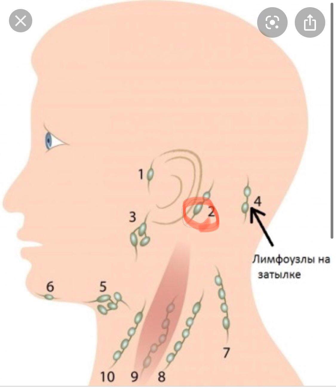 Лимфоузлы затылочные причины. Воспалённые околушныее лимфоузлы. Шейные лимфоузлы расположение и ушные. Лимфоузлы шеи схема воспаление. Околоушные лимфатические узлы.