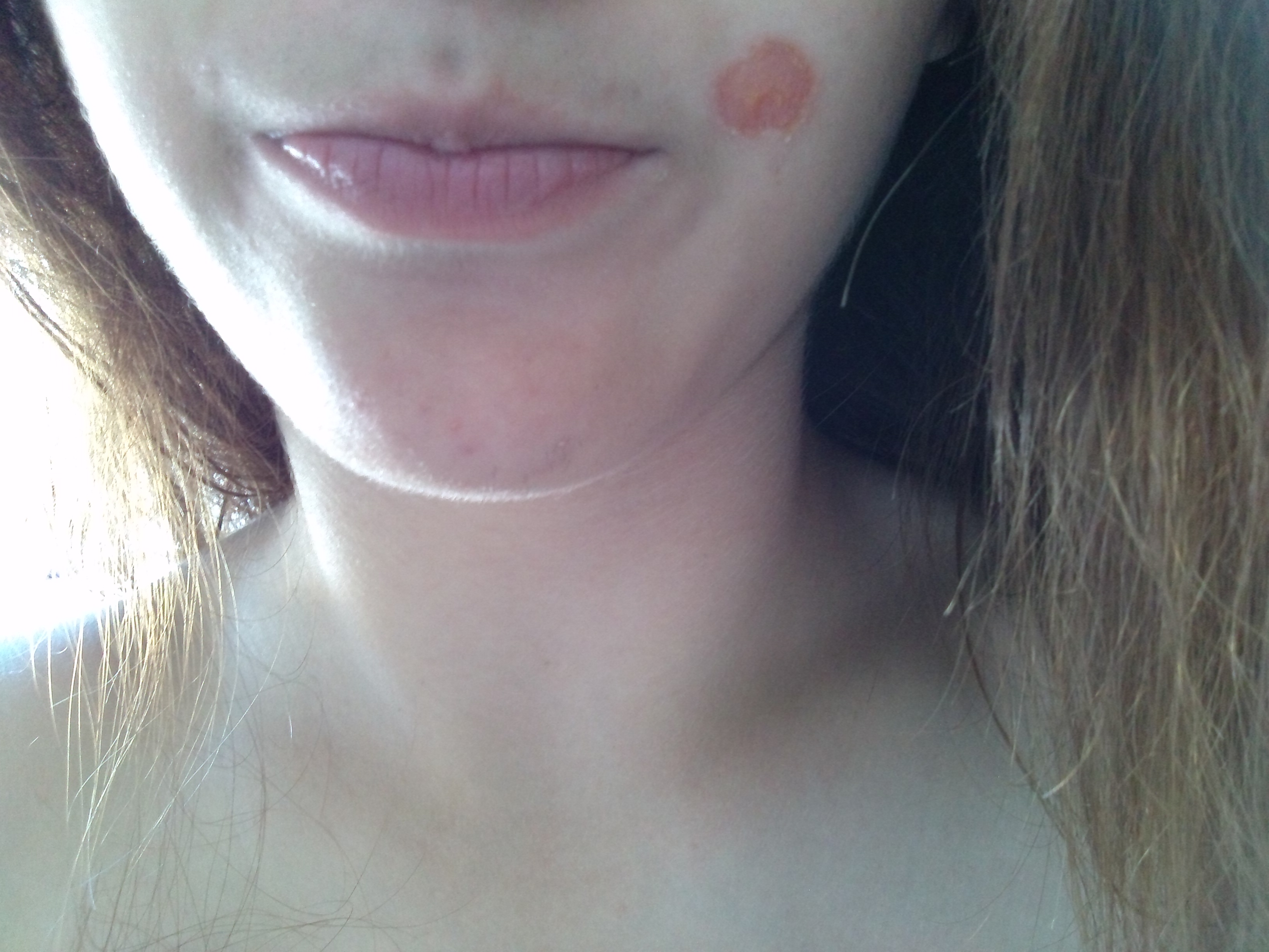 Macke Im Gesicht Abdecken Beauty Heilung