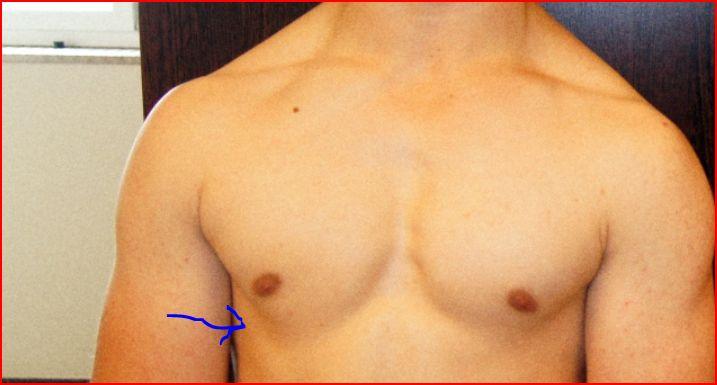 Männlich, 17, Brustkrebs überhaupt möglich? (Gesundheit, Medizin, Arzt) Männlich, 17, Brustkrebs überhaupt möglich? (Gesundheit, Medizin, Arzt)