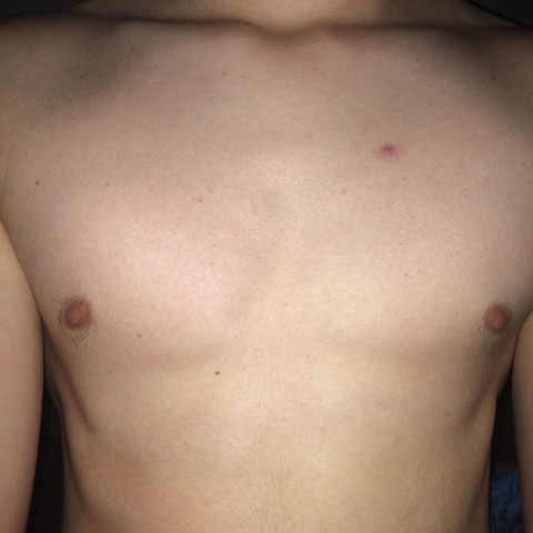 Mannlich Brust Asymmetrie Form Manner