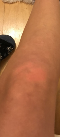 Manchmal Rosa Flecken Auf Der Haut Medizin Arzt Manchmal Rosa Flecken Auf Der Haut Medizin Arzt