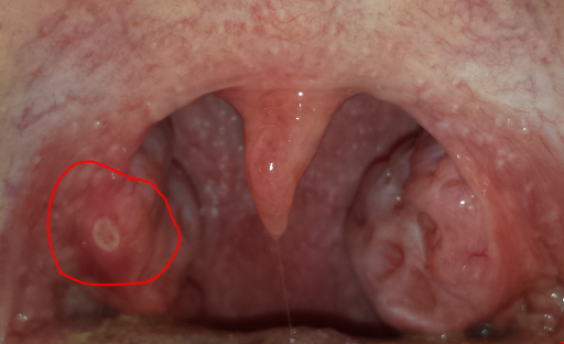 Mandel Abszess? (Hals, Mandeln) Mandel Abszess? (Hals, Mandeln)
